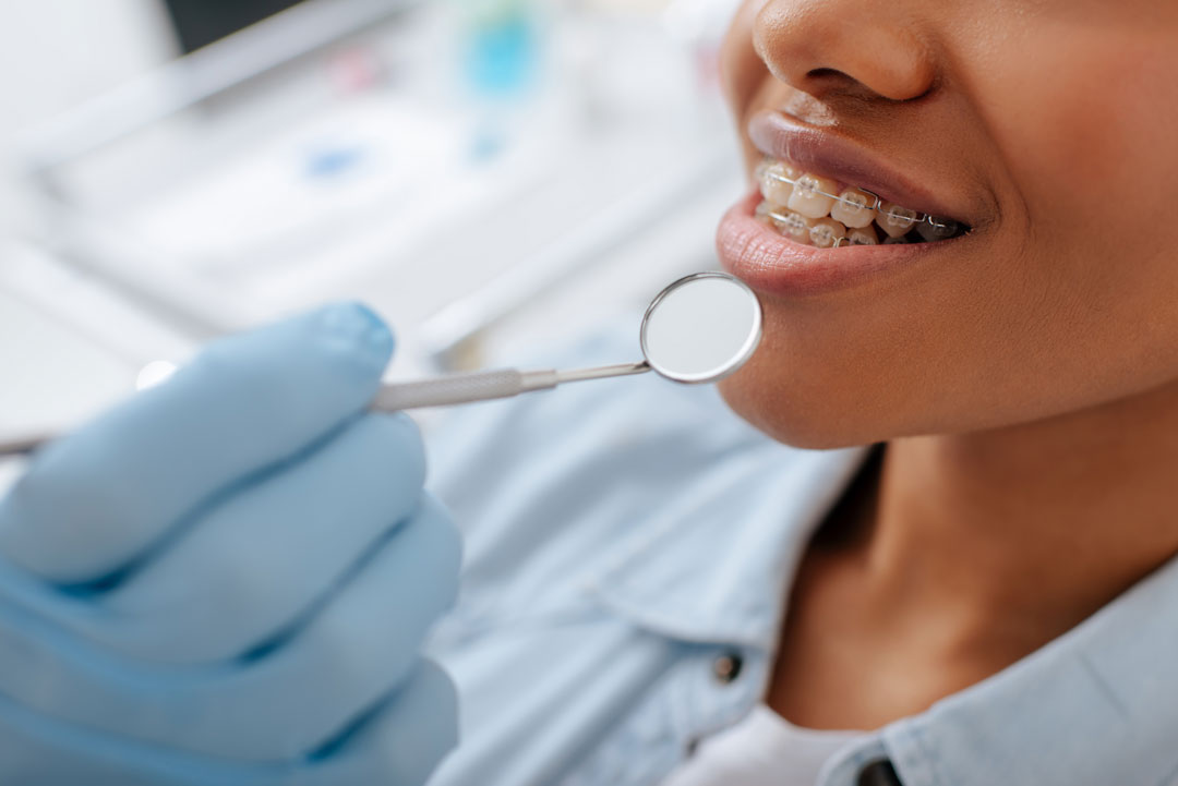 Adult Orthodontic Treatment