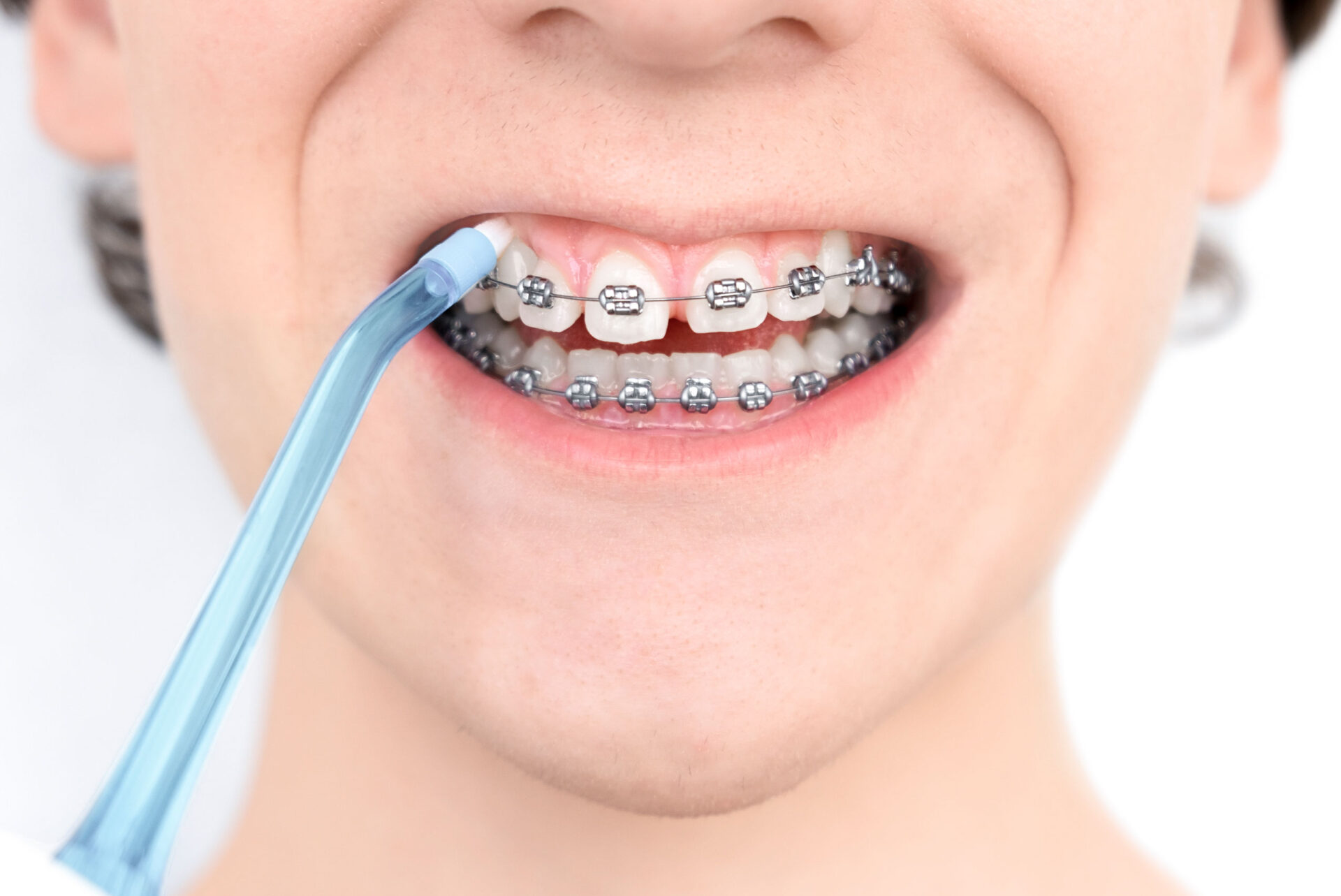 Young person with braces practicing good oral hygiene