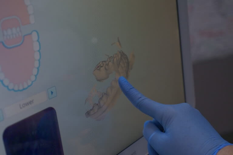 image of a gloved hand pointing at a dental scan